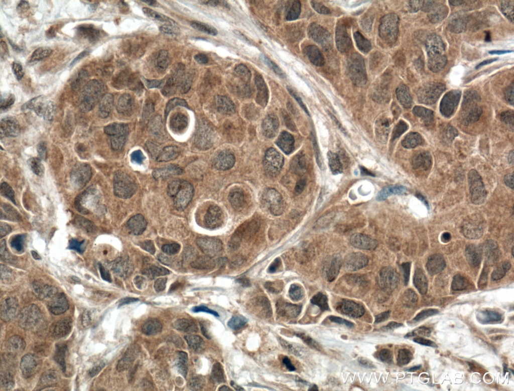 Immunohistochemistry (IHC) staining of human breast cancer tissue using DGKB Polyclonal antibody (24320-1-AP)