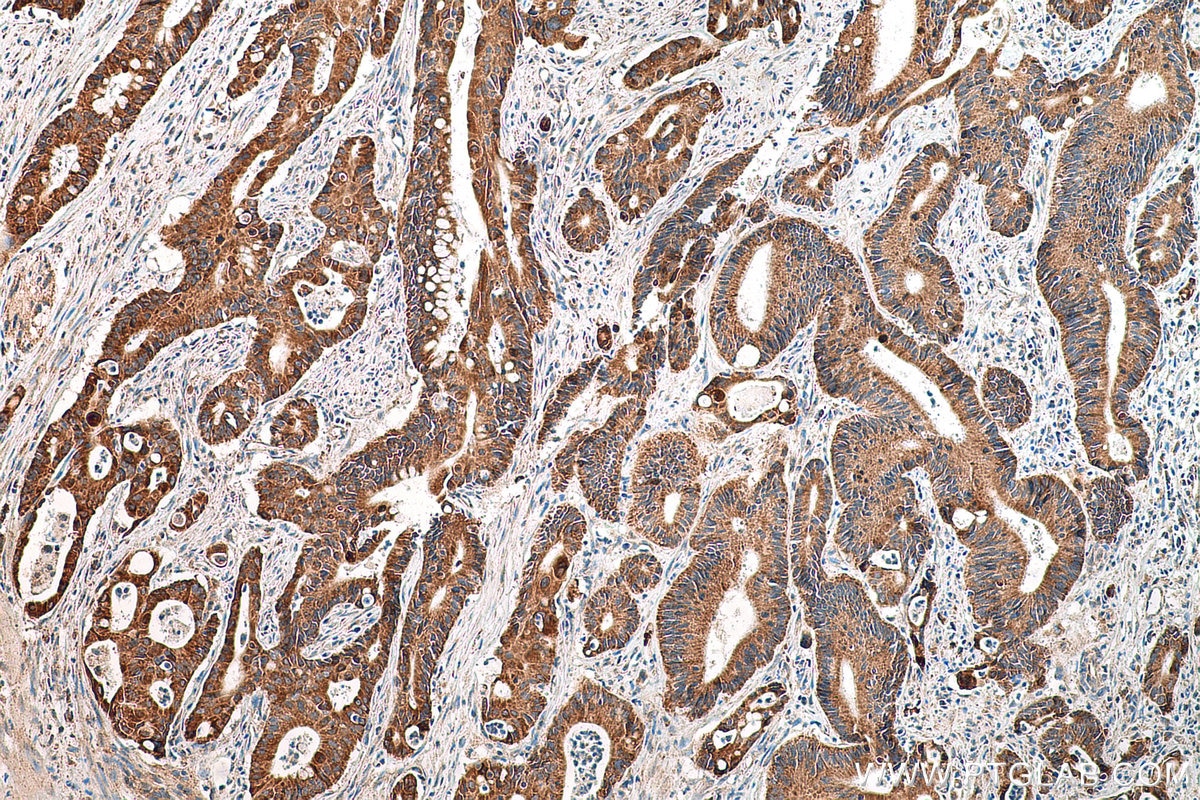 Immunohistochemistry (IHC) staining of human colon cancer tissue using DGKE Polyclonal antibody (11900-1-AP)