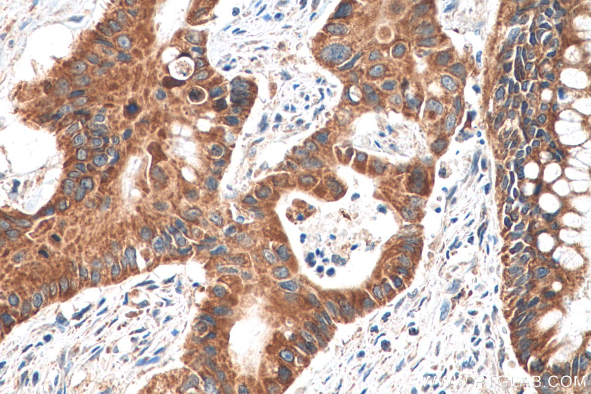 Immunohistochemistry (IHC) staining of human colon cancer tissue using DGKE Polyclonal antibody (11900-1-AP)