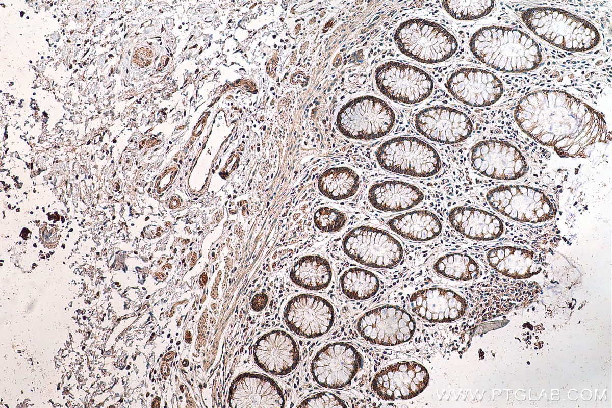 Immunohistochemistry (IHC) staining of human colon cancer tissue using DGKE Polyclonal antibody (11900-1-AP)