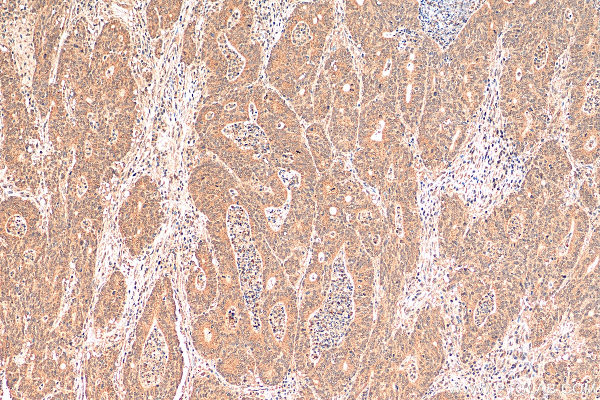 Immunohistochemistry (IHC) staining of human colon cancer tissue using DGKQ Polyclonal antibody (17885-1-AP)