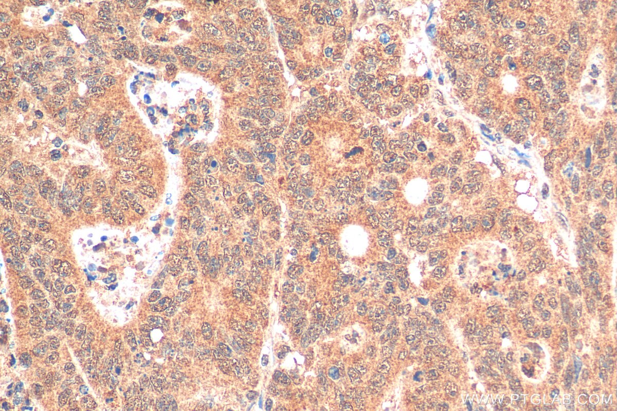 Immunohistochemistry (IHC) staining of human colon cancer tissue using DGKQ Polyclonal antibody (17885-1-AP)