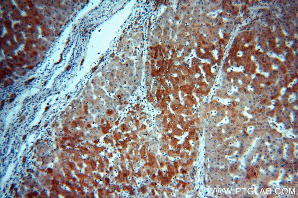 Immunohistochemistry (IHC) staining of human hepatocirrhosis tissue using dGK Polyclonal antibody (16314-1-AP)