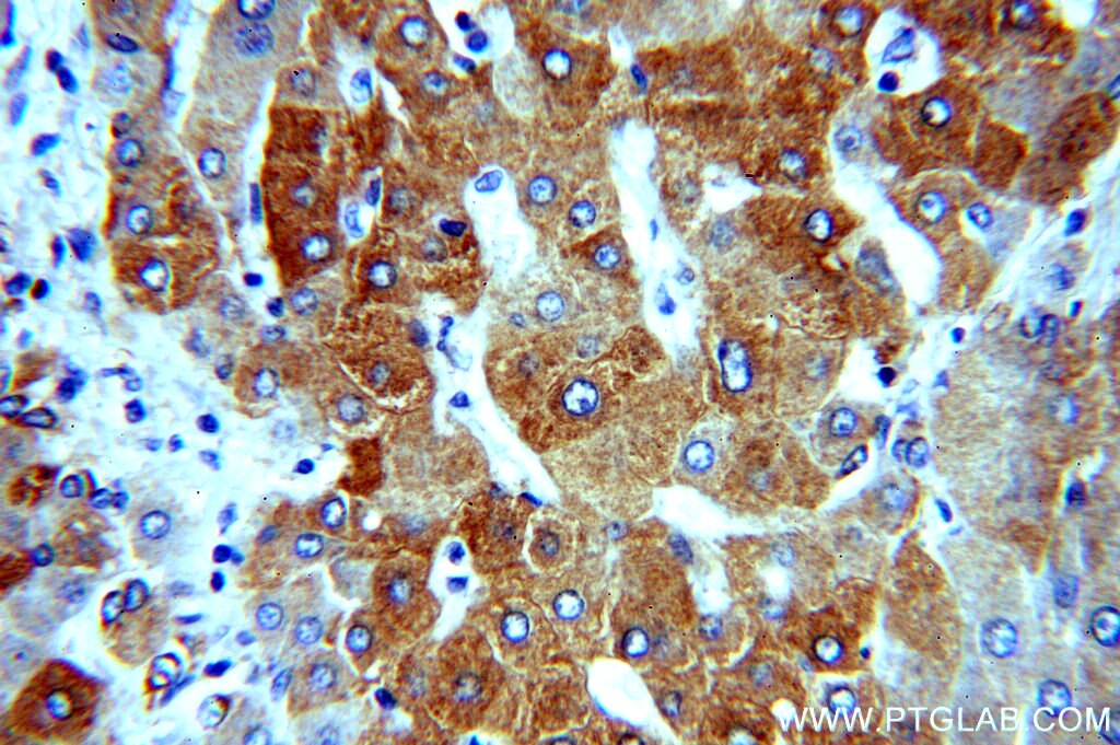 Immunohistochemistry (IHC) staining of human hepatocirrhosis tissue using dGK Polyclonal antibody (16314-1-AP)