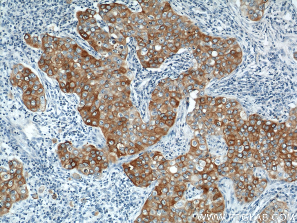 Immunohistochemistry (IHC) staining of human breast cancer tissue using DHCR24 Polyclonal antibody (10471-1-AP)