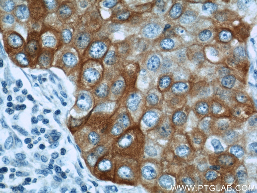 Immunohistochemistry (IHC) staining of human breast cancer tissue using DHCR24 Polyclonal antibody (10471-1-AP)