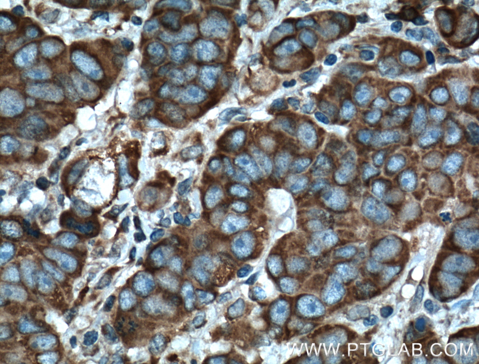 Immunohistochemistry (IHC) staining of human prostate cancer tissue using DHCR24 Monoclonal antibody (60028-1-Ig)