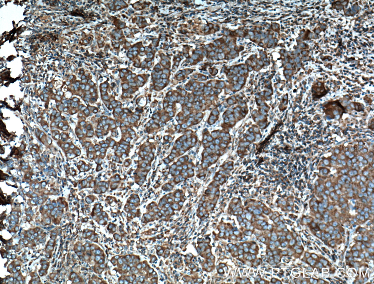 IHC staining of human prostate cancer using 60028-1-Ig