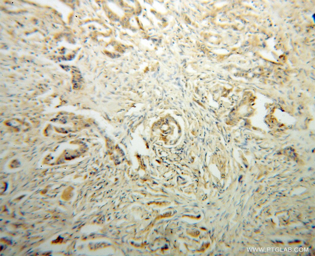 Immunohistochemistry (IHC) staining of human colon cancer tissue using DHDH Polyclonal antibody (13900-1-AP)