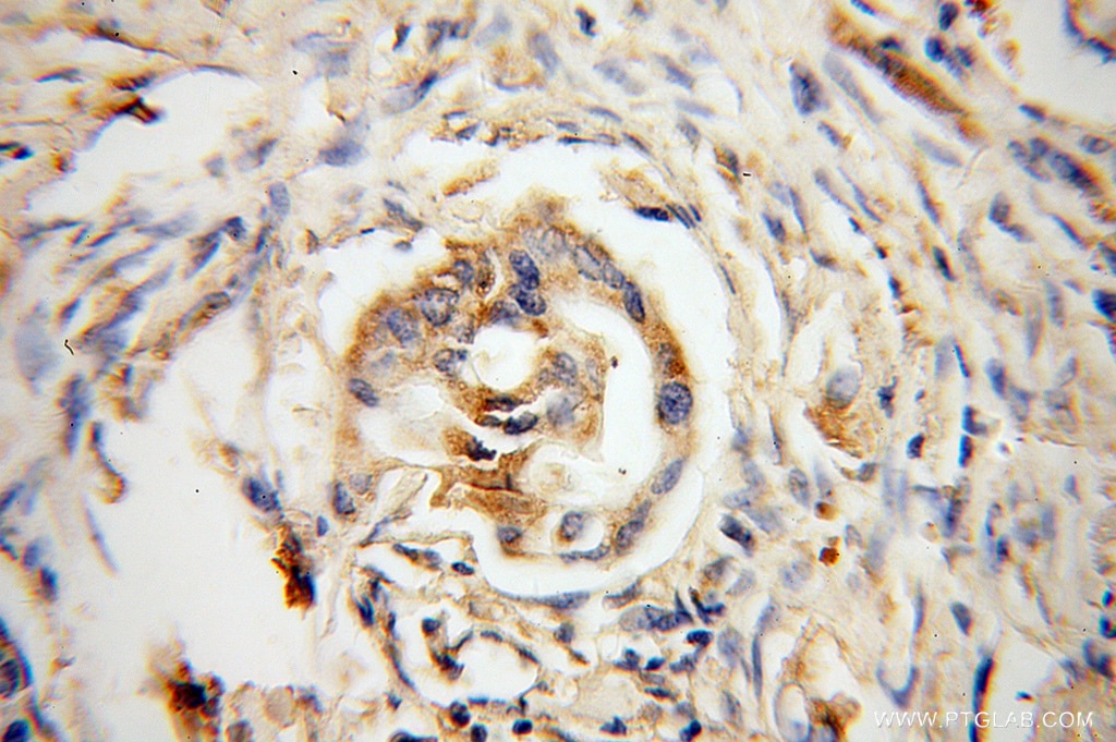 Immunohistochemistry (IHC) staining of human colon cancer tissue using DHDH Polyclonal antibody (13900-1-AP)