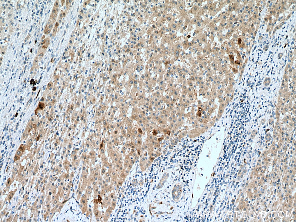 Immunohistochemistry (IHC) staining of human liver cancer tissue using DHFR Polyclonal antibody (15194-1-AP)