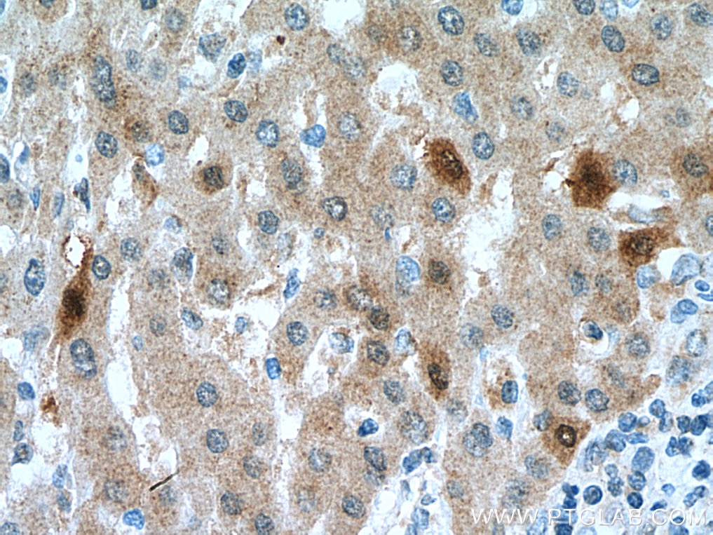 Immunohistochemistry (IHC) staining of human liver cancer tissue using DHFR Polyclonal antibody (15194-1-AP)