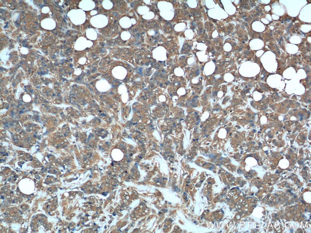 Immunohistochemistry (IHC) staining of human breast cancer tissue using DHFR Polyclonal antibody (15194-1-AP)
