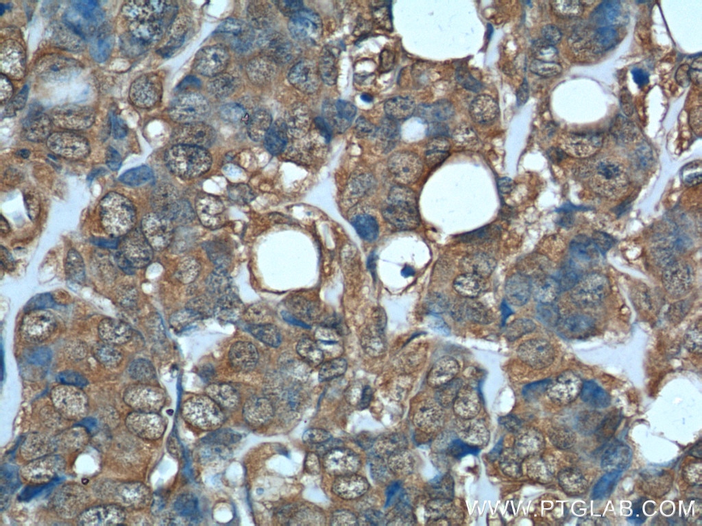 Immunohistochemistry (IHC) staining of human breast cancer tissue using DHFR Polyclonal antibody (15194-1-AP)