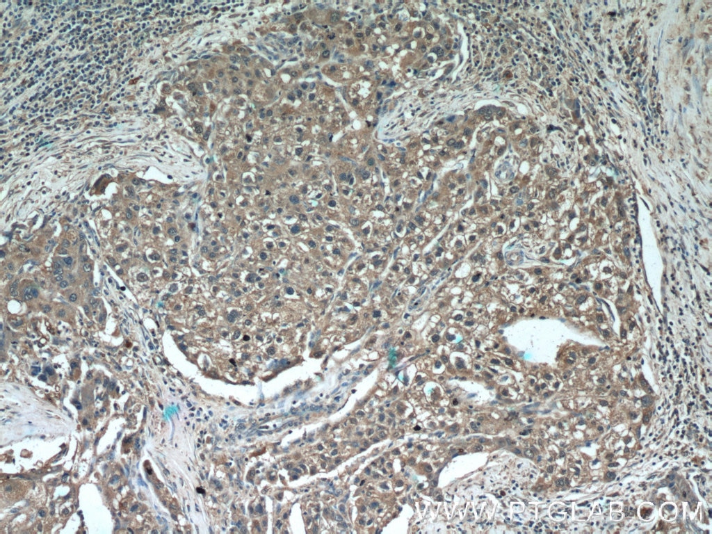 Immunohistochemistry (IHC) staining of human liver cancer tissue using DHFR Polyclonal antibody (15194-1-AP)