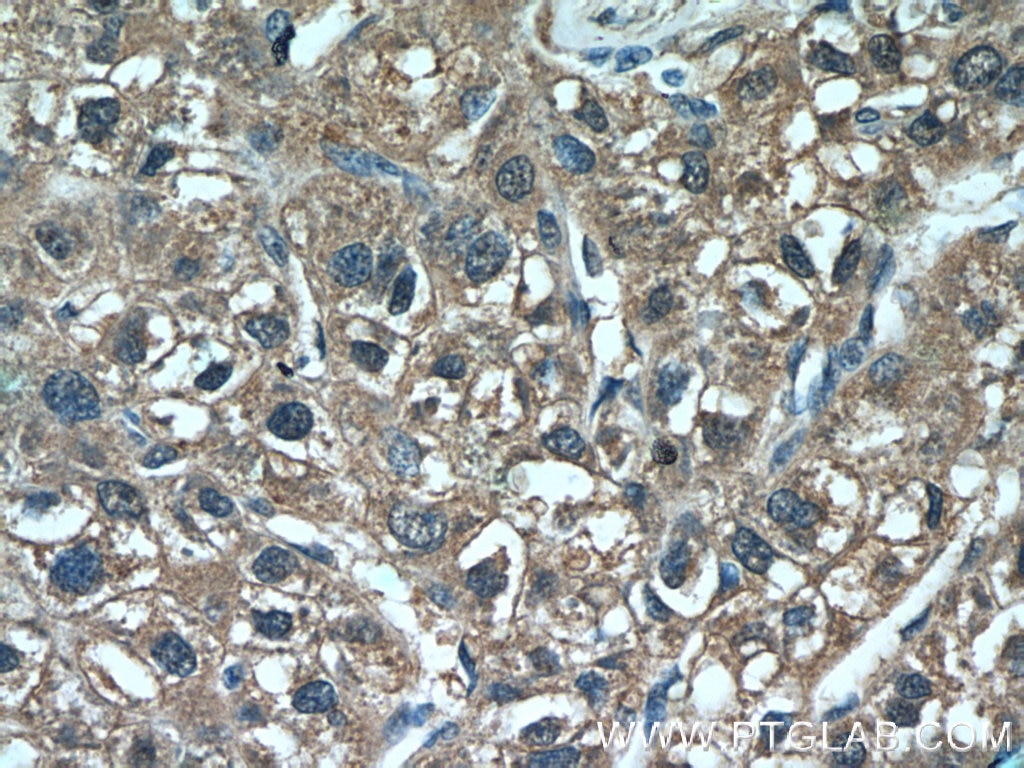 Immunohistochemistry (IHC) staining of human liver cancer tissue using DHFR Polyclonal antibody (15194-1-AP)