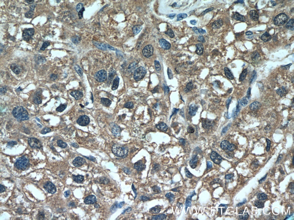 Immunohistochemistry (IHC) staining of human liver cancer tissue using DHFR Polyclonal antibody (15194-1-AP)