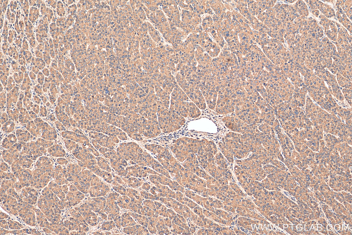 IHC staining of human liver cancer using 81021-1-RR
