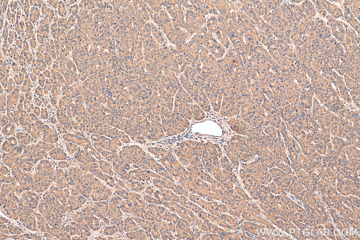 Immunohistochemistry (IHC) staining of human liver cancer tissue using DHFR Recombinant antibody (81021-1-RR)