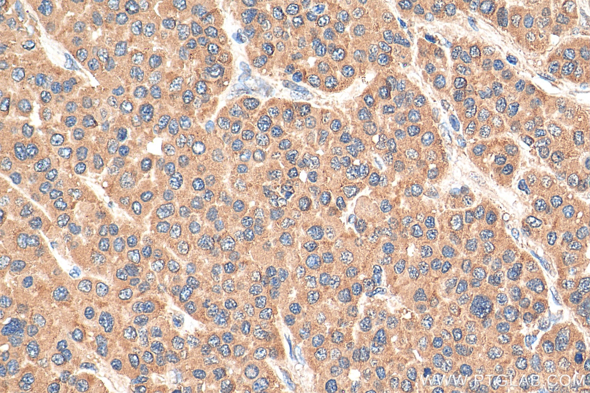 Immunohistochemistry (IHC) staining of human liver cancer tissue using DHFR Recombinant antibody (81021-1-RR)