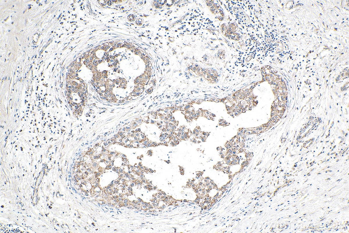Immunohistochemistry (IHC) staining of human breast cancer tissue using DHODH Polyclonal antibody (14877-1-AP)