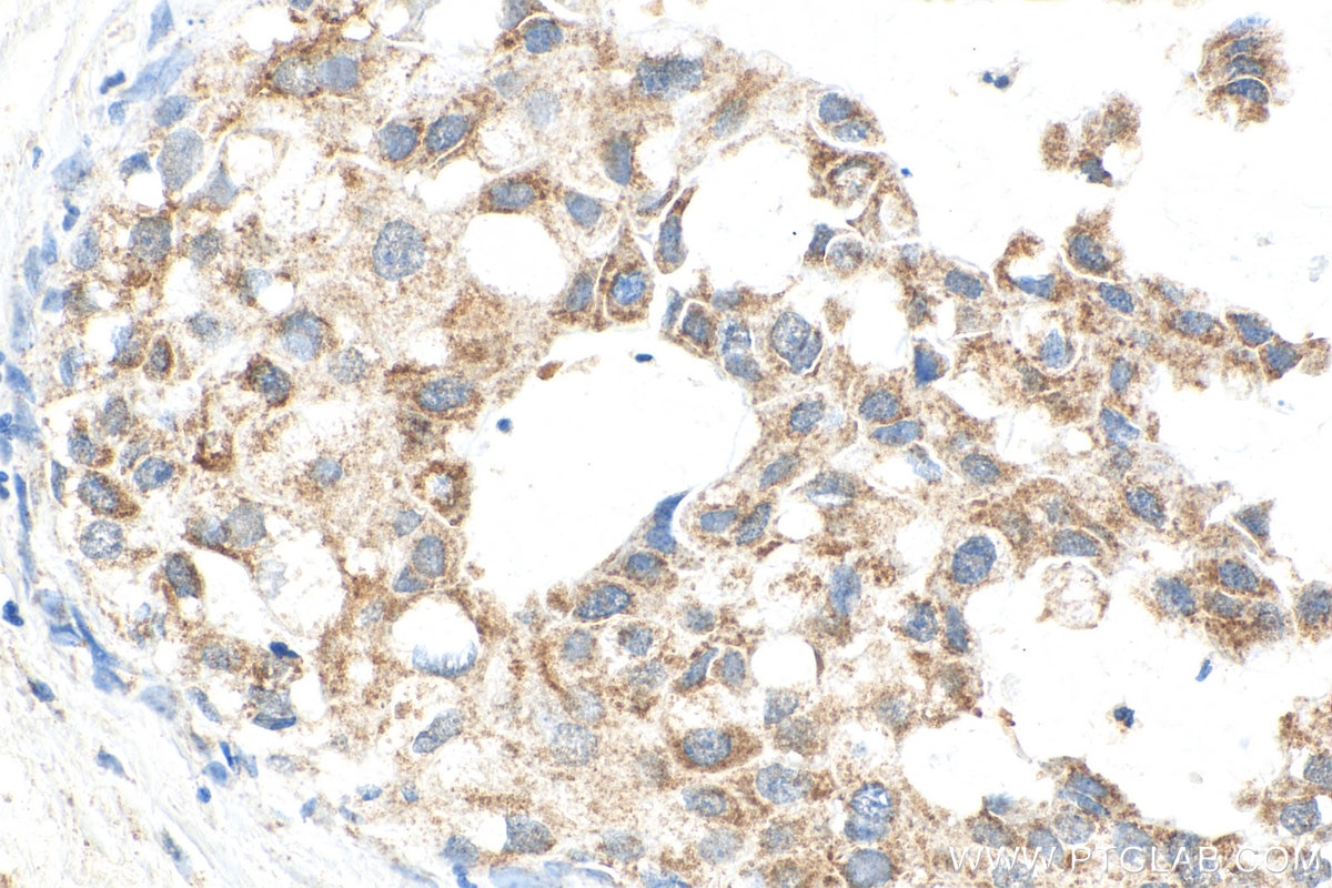 Immunohistochemistry (IHC) staining of human breast cancer tissue using DHODH Polyclonal antibody (14877-1-AP)