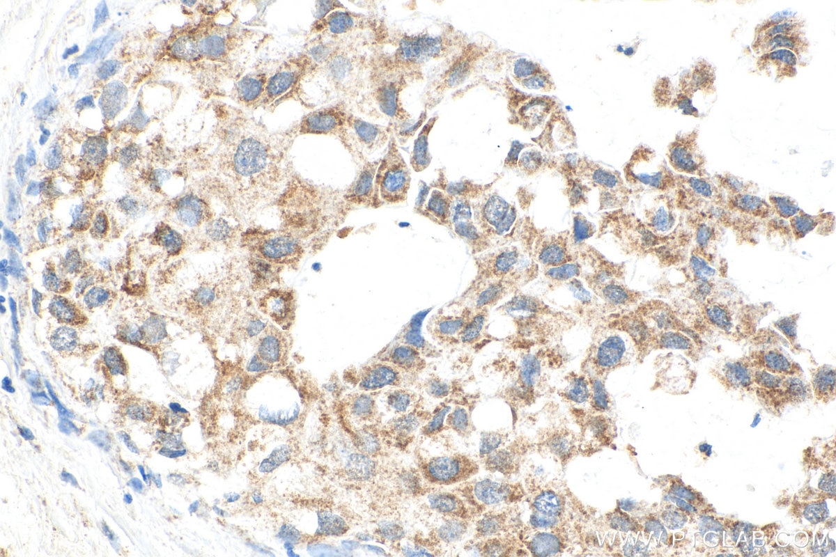 IHC staining of human breast cancer using 14877-1-AP