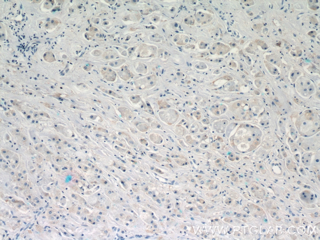 Immunohistochemistry (IHC) staining of human breast cancer tissue using DHRS11 Polyclonal antibody (20172-1-AP)