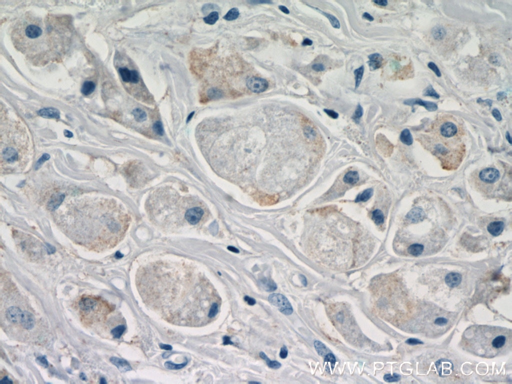 Immunohistochemistry (IHC) staining of human breast cancer tissue using DHRS11 Polyclonal antibody (20172-1-AP)