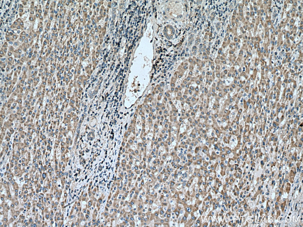 Immunohistochemistry (IHC) staining of human liver cancer tissue using DHRS2 Polyclonal antibody (15735-1-AP)