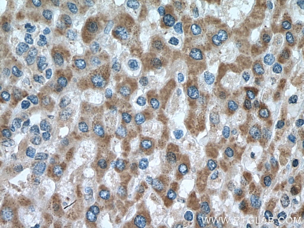 Immunohistochemistry (IHC) staining of human liver cancer tissue using DHRS2 Polyclonal antibody (15735-1-AP)