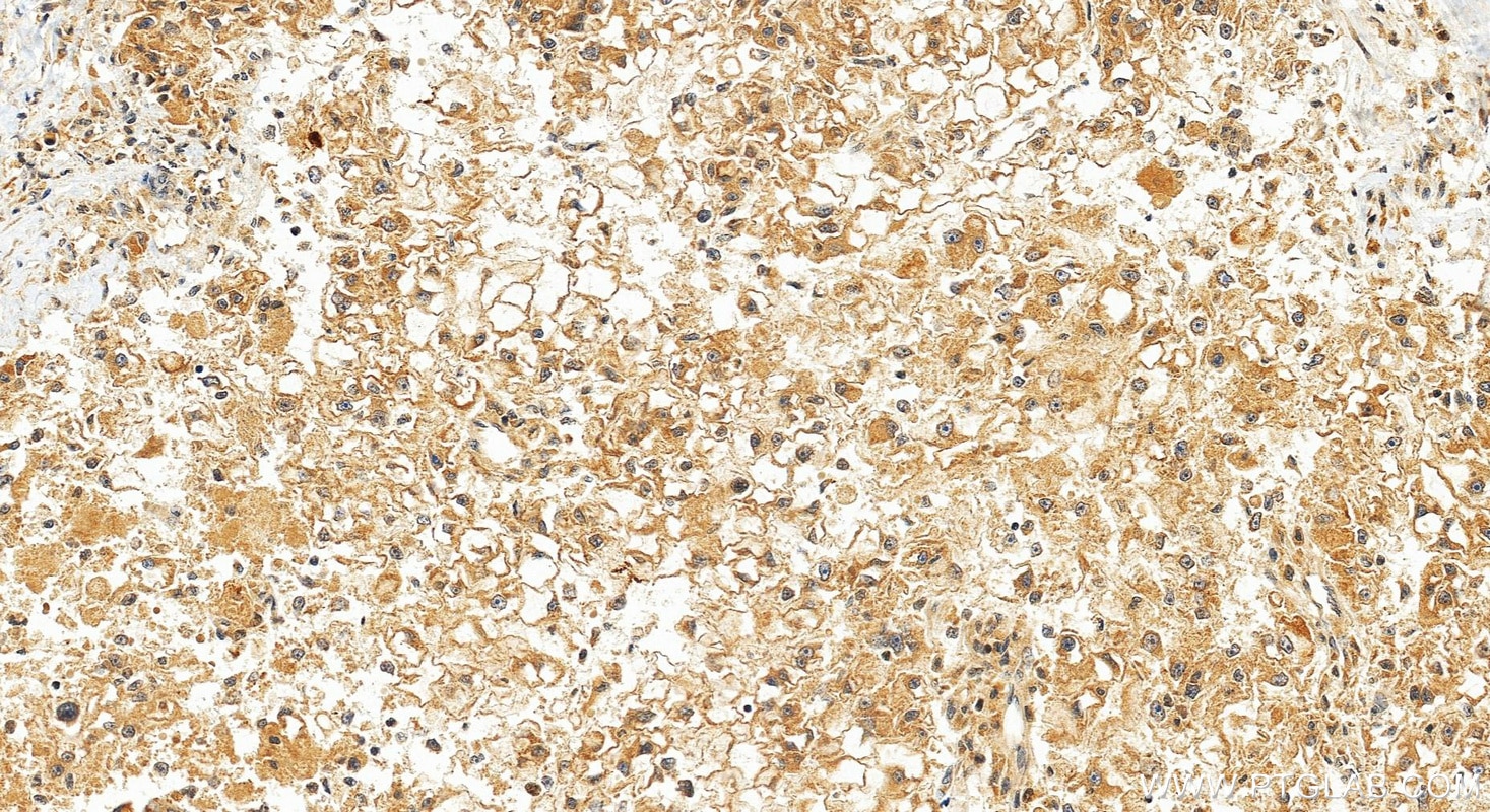 IHC staining of Hepatocellular carcinoma using RMX00088 Immunohistochemistry (IHC) staining of Hepatocellular carcinoma tissue using Multi-rAb® DHRS2 Multi-Recombinant antibody (RMX00088)