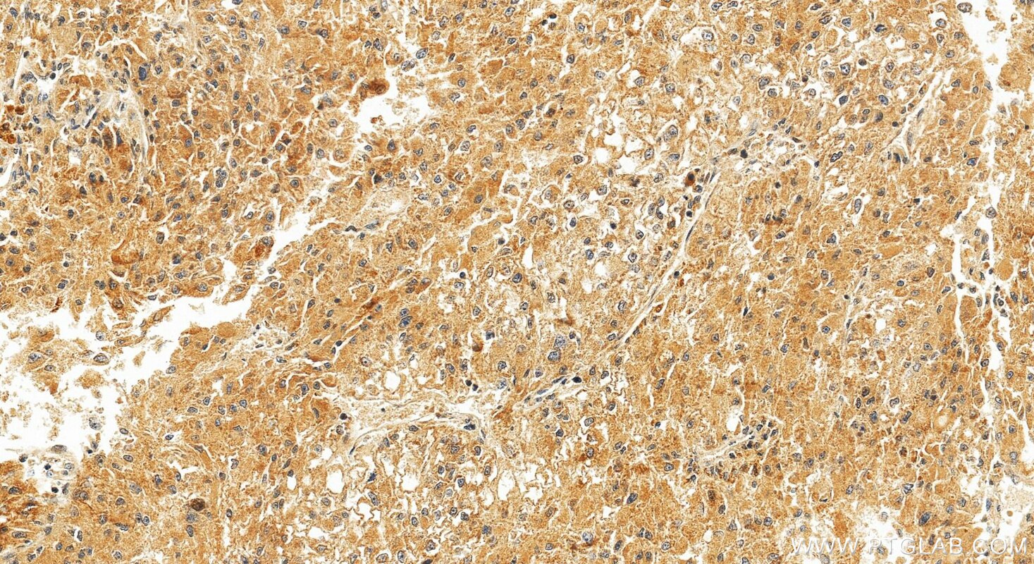 IHC staining of Hepatocellular carcinoma using RMX00088 Immunohistochemistry (IHC) staining of Hepatocellular carcinoma tissue using Multi-rAb® DHRS2 Multi-Recombinant antibody (RMX00088)