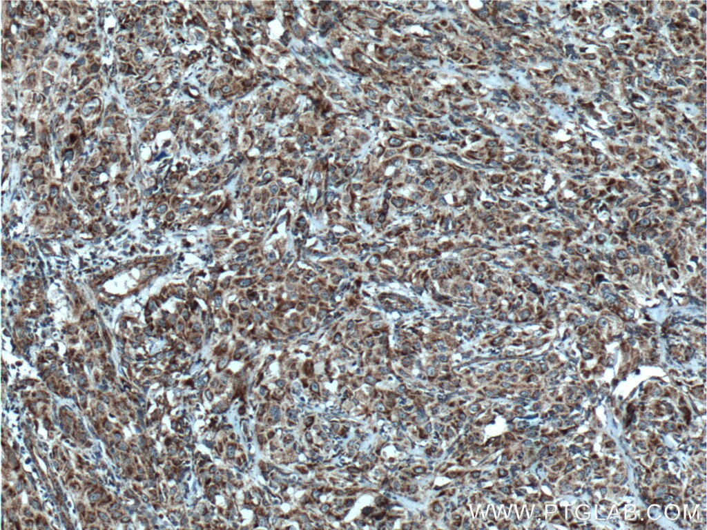 Immunohistochemistry (IHC) staining of human cervical cancer tissue using DHRS4 Polyclonal antibody (15279-1-AP)
