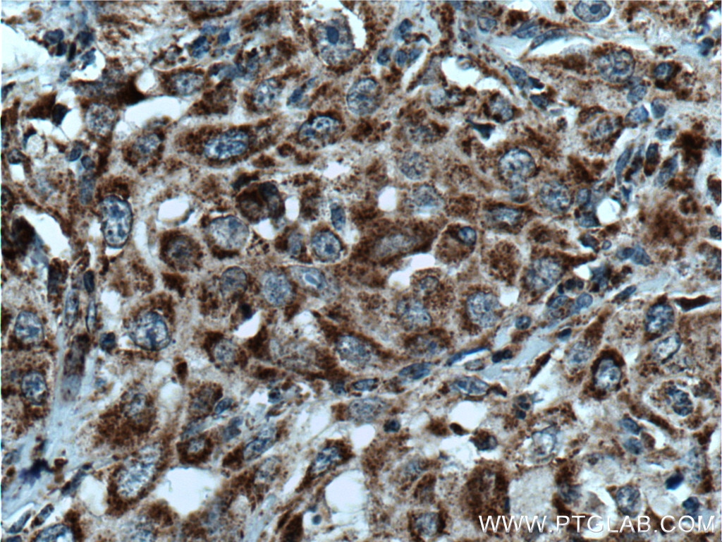 Immunohistochemistry (IHC) staining of human cervical cancer tissue using DHRS4 Polyclonal antibody (15279-1-AP)