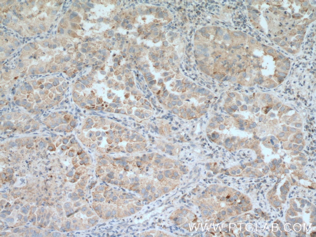 Immunohistochemistry (IHC) staining of human lung cancer tissue using DHRS9 Polyclonal antibody (14560-1-AP)