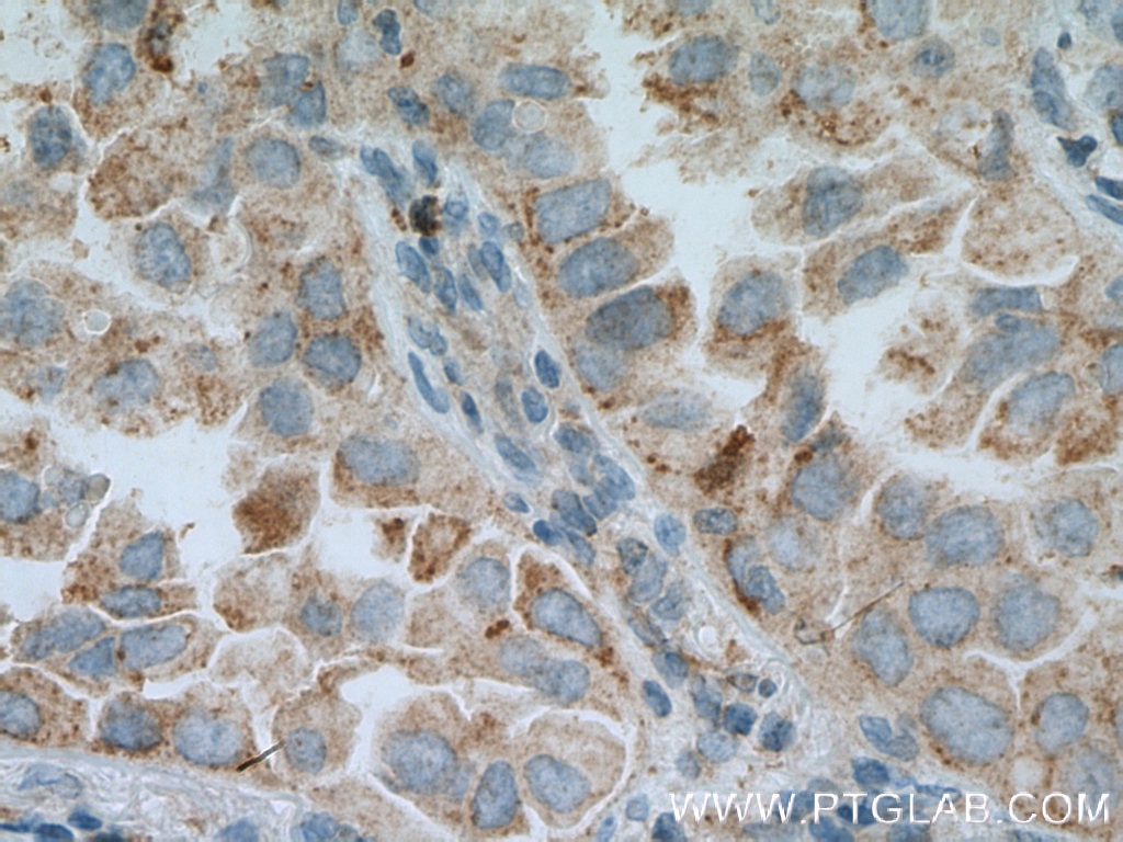 Immunohistochemistry (IHC) staining of human lung cancer tissue using DHRS9 Polyclonal antibody (14560-1-AP)