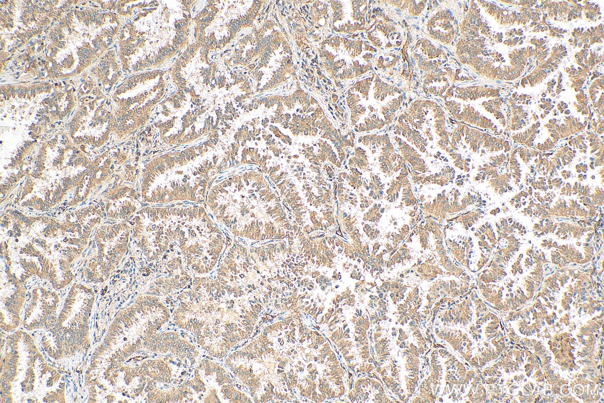 Immunohistochemistry (IHC) staining of human lung cancer tissue using DHTKD1 Polyclonal antibody (27493-1-AP)