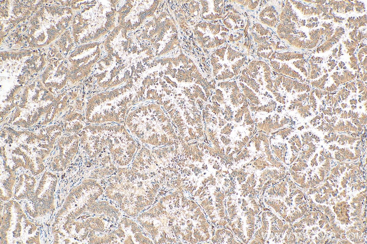 IHC staining of human lung cancer using 27493-1-AP