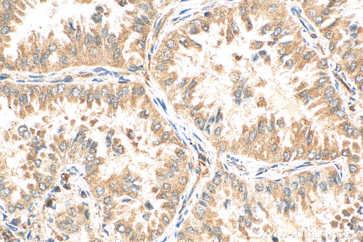 Immunohistochemistry (IHC) staining of human lung cancer tissue using DHTKD1 Polyclonal antibody (27493-1-AP)