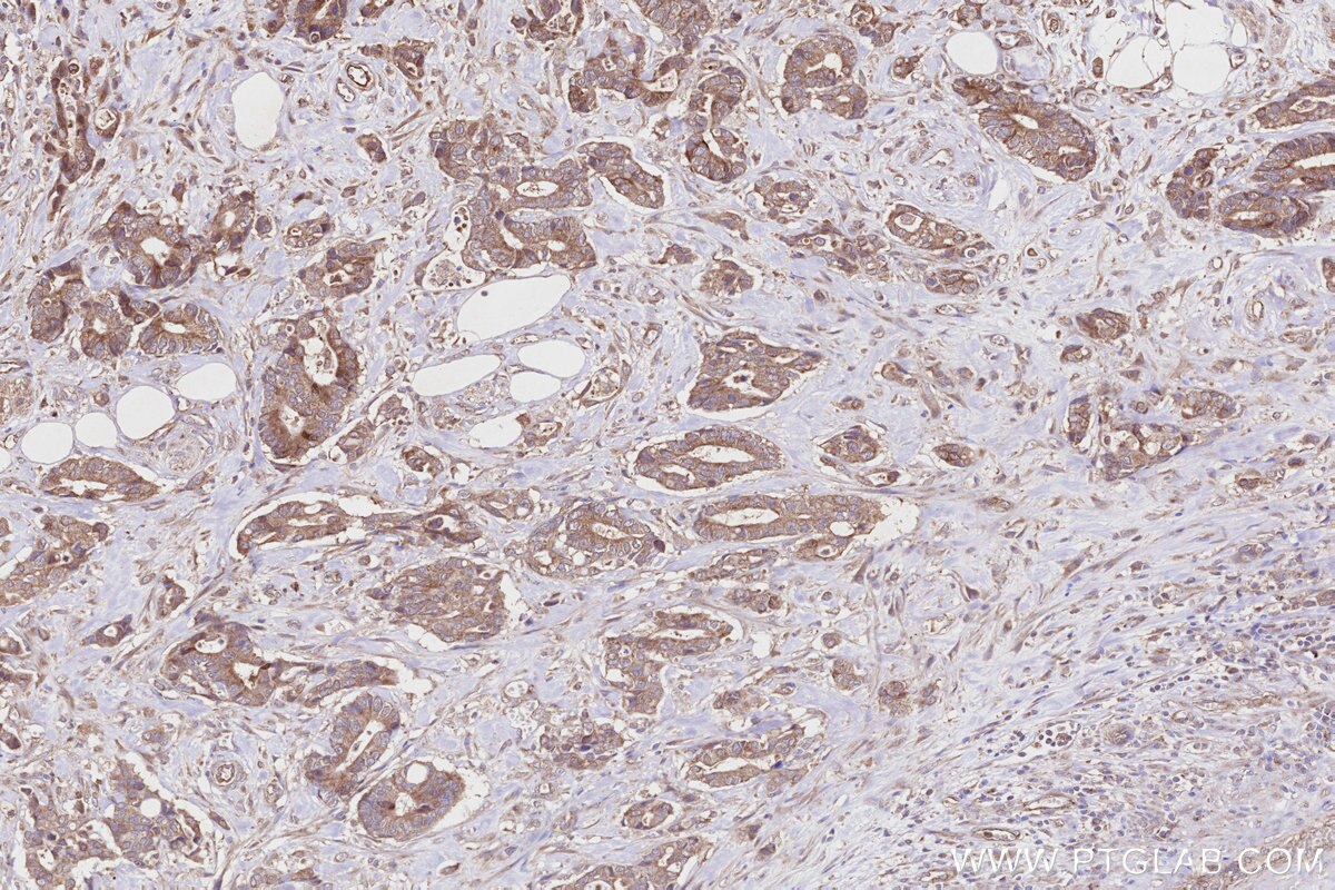 Immunohistochemistry (IHC) staining of human rectal cancer tissue using DHTKD1 Polyclonal antibody (27493-1-AP)