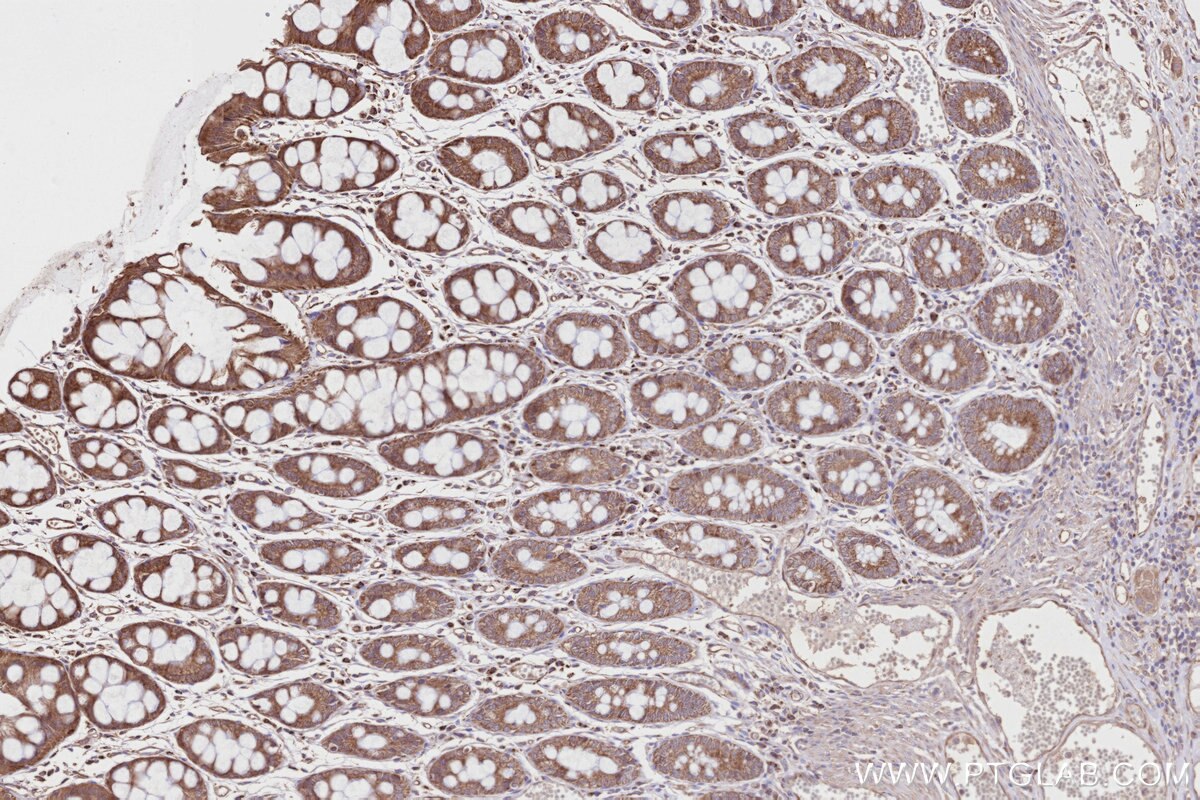Immunohistochemistry (IHC) staining of human rectal cancer tissue using DHTKD1 Polyclonal antibody (27493-1-AP)