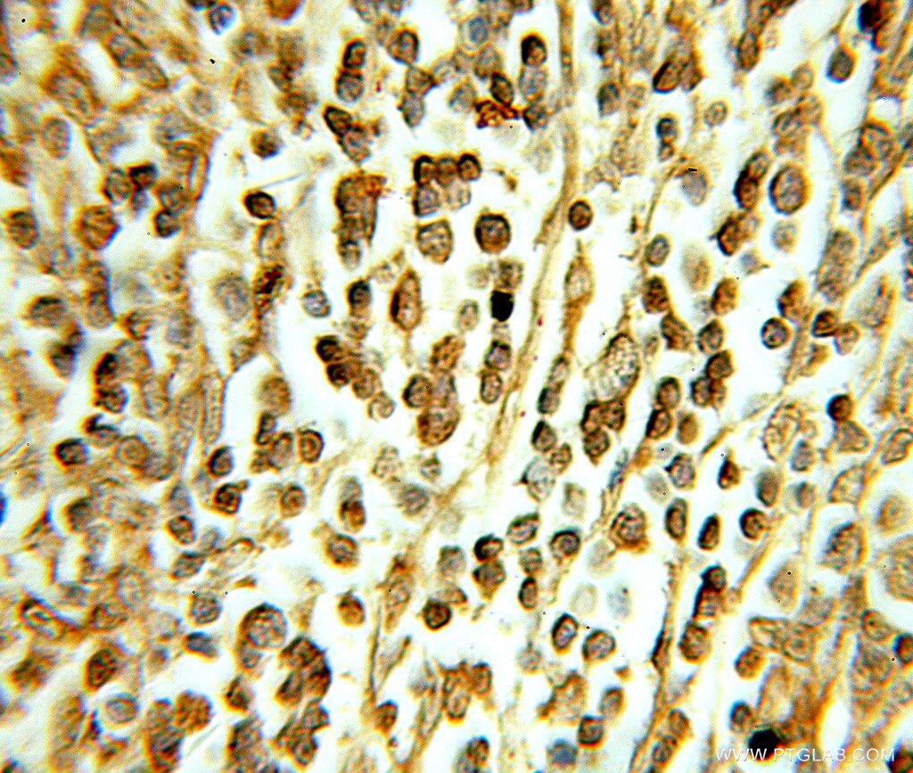 Immunohistochemistry (IHC) staining of human lymphoma tissue using DHX16 Polyclonal antibody (11021-1-AP)