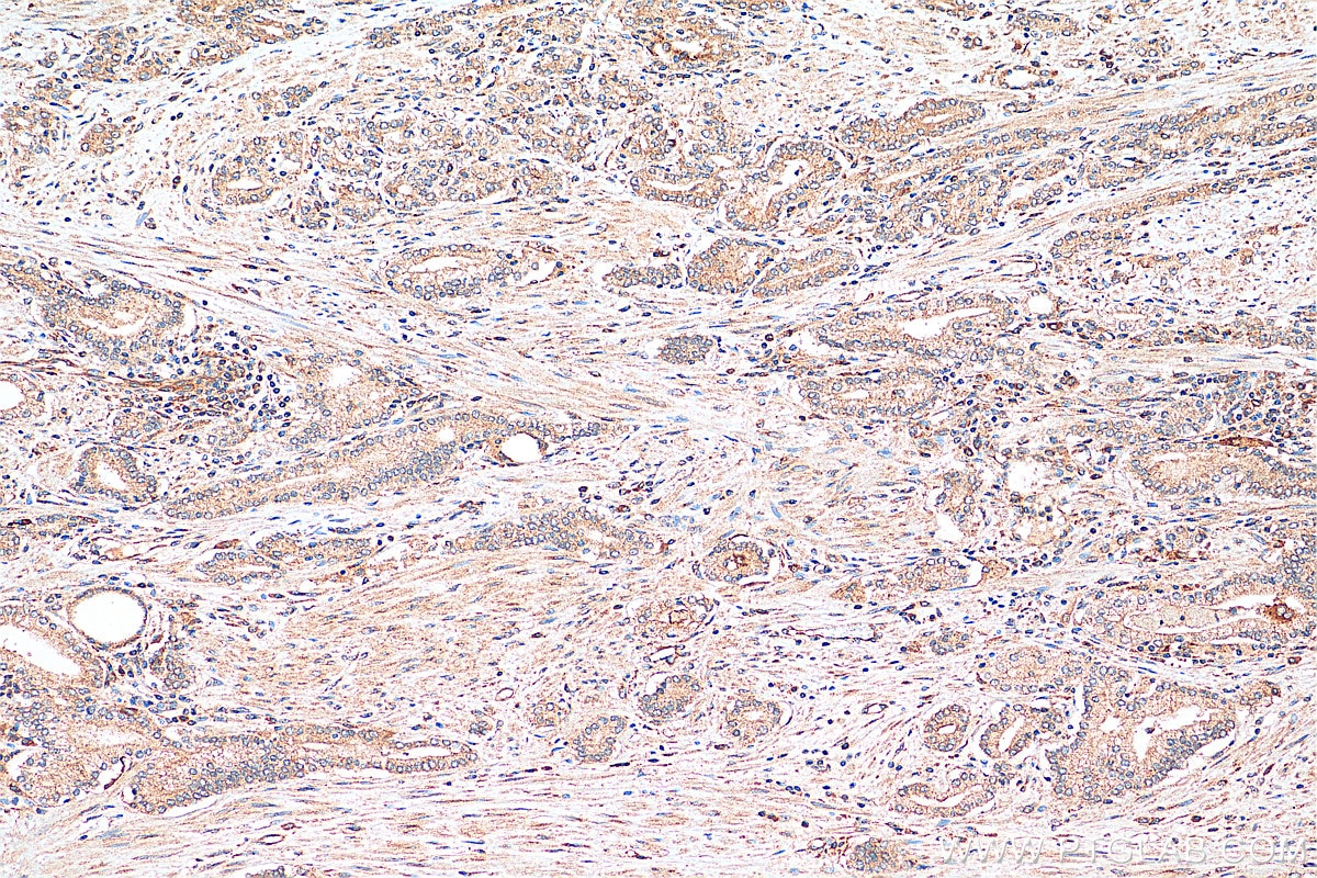 Immunohistochemistry (IHC) staining of human prostate cancer tissue using DHX36 Polyclonal antibody (13159-1-AP)