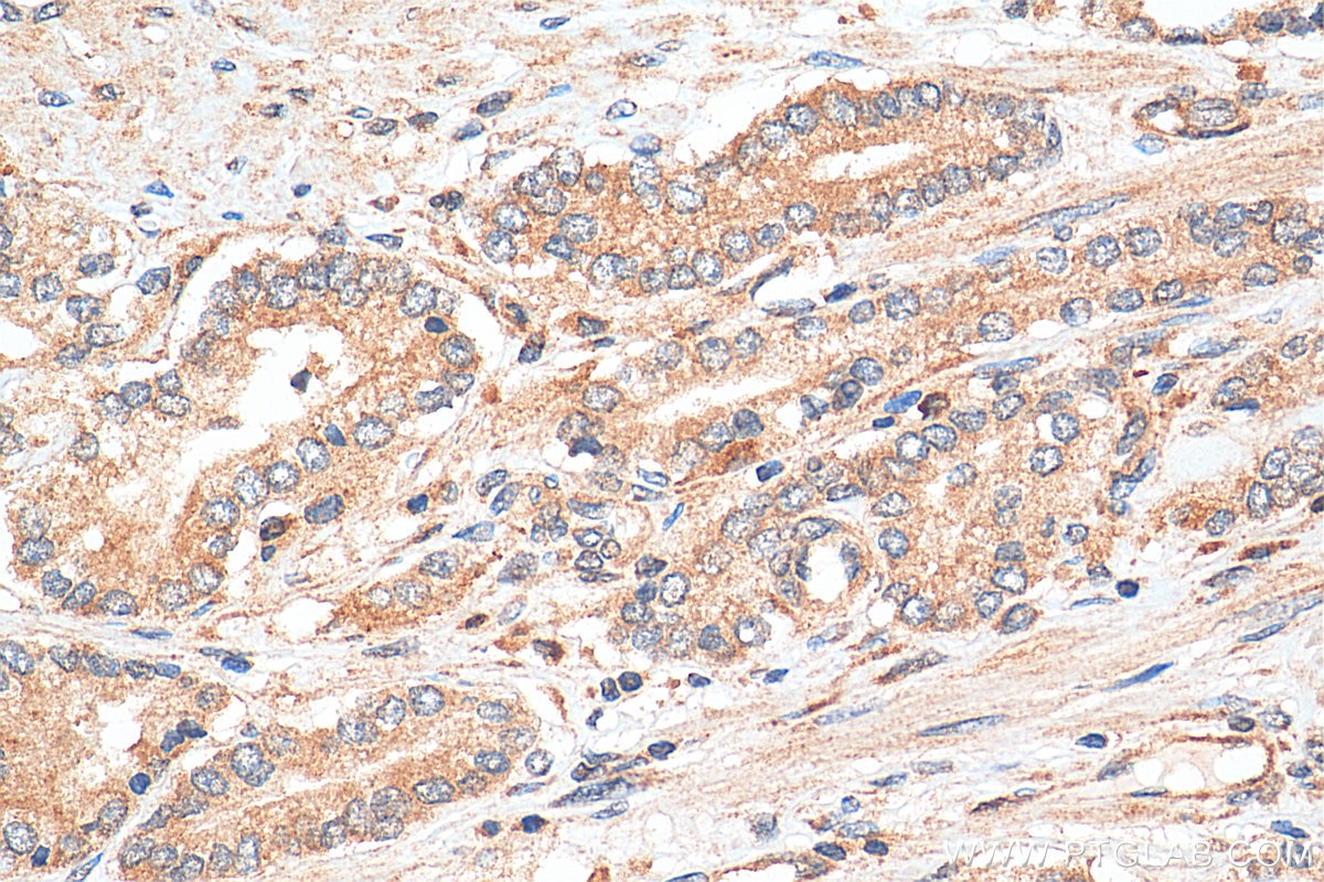 IHC staining of human prostate cancer using 13159-1-AP