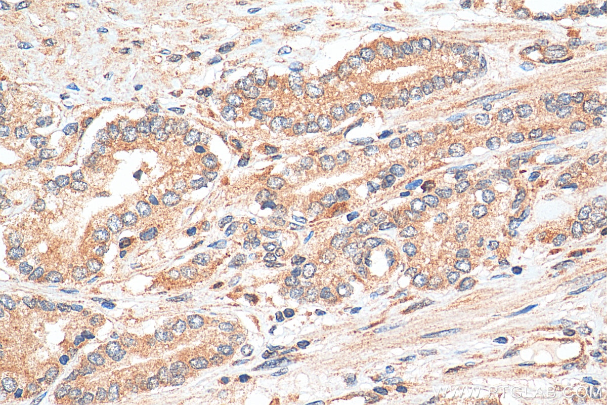 Immunohistochemistry (IHC) staining of human prostate cancer tissue using DHX36 Polyclonal antibody (13159-1-AP)