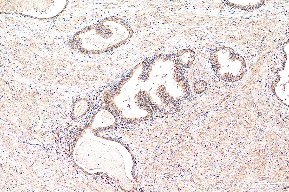 Immunohistochemistry (IHC) staining of human prostate cancer tissue using DHX36 Polyclonal antibody (13159-1-AP)
