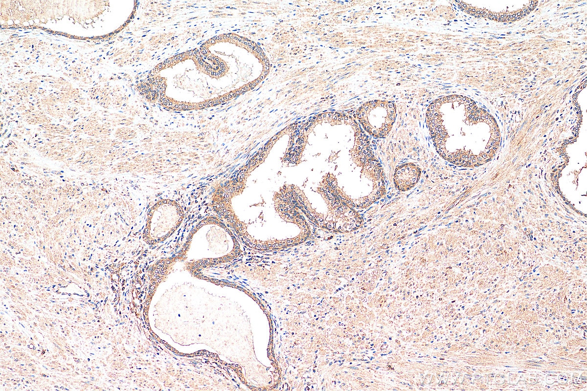 IHC staining of human prostate cancer using 13159-1-AP