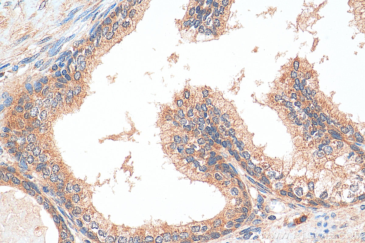 Immunohistochemistry (IHC) staining of human prostate cancer tissue using DHX36 Polyclonal antibody (13159-1-AP)