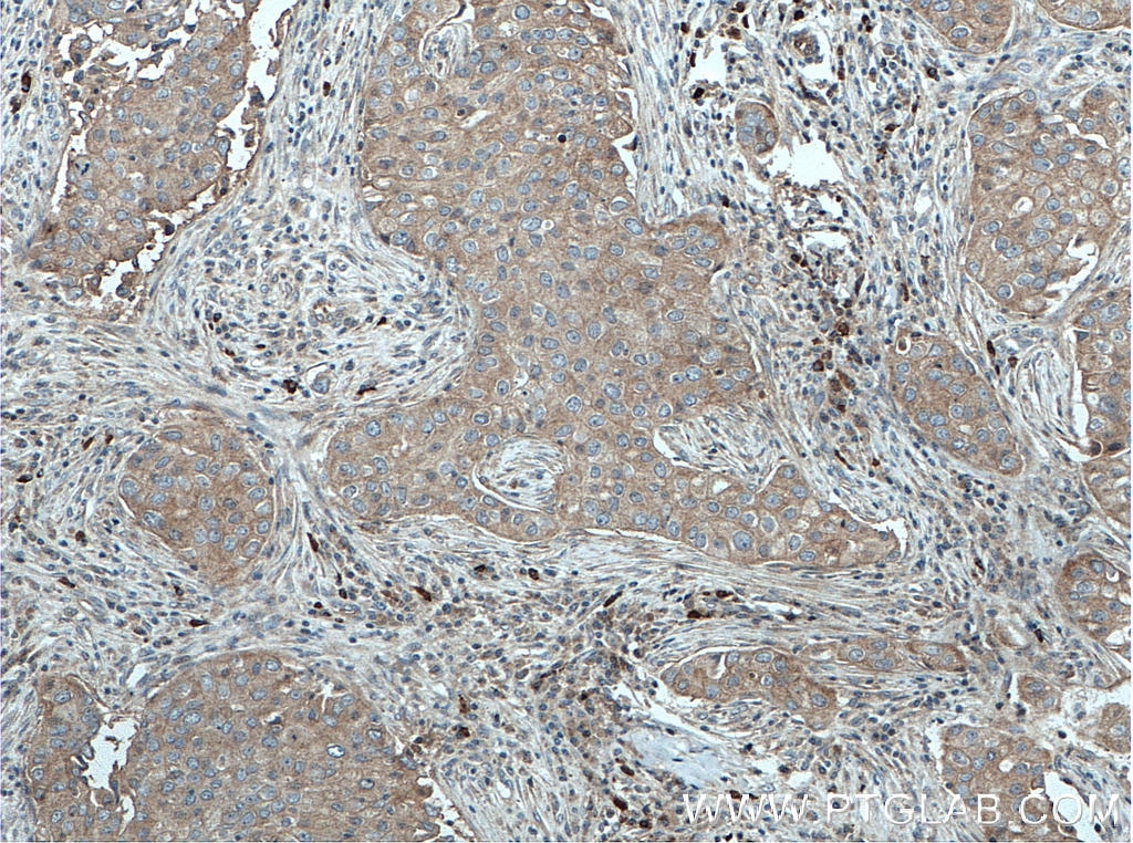 IHC staining of human breast cancer using 11355-1-AP